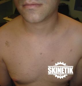 piercing_skinetik_micro_dermal02