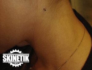 piercing_skinetik_micro_dermal107