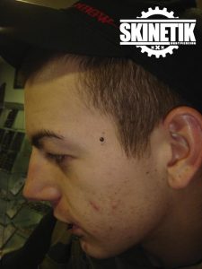 piercing_skinetik_micro_dermal17
