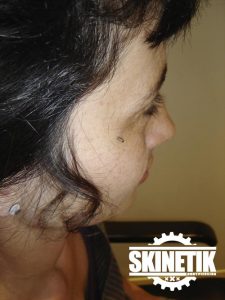 piercing_skinetik_micro_dermal25