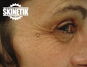 piercing_skinetik_micro_dermal29