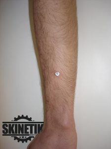 piercing_skinetik_micro_dermal40