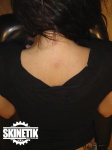 piercing_skinetik_micro_dermal98