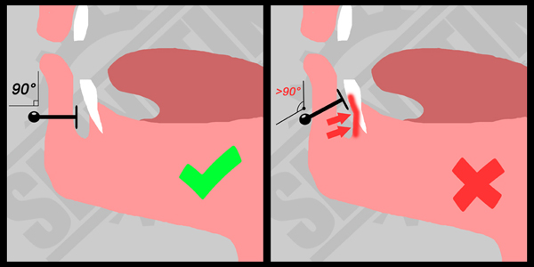 PIERCING ET DECHAUSSEMENTS DENTAIRES