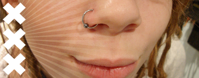 UN ANNEAU POUR LA CICATRISATION